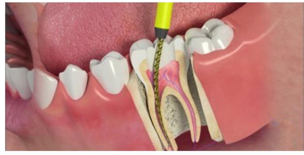 عصب کشی دندان یا درمان ریشه چیست؟