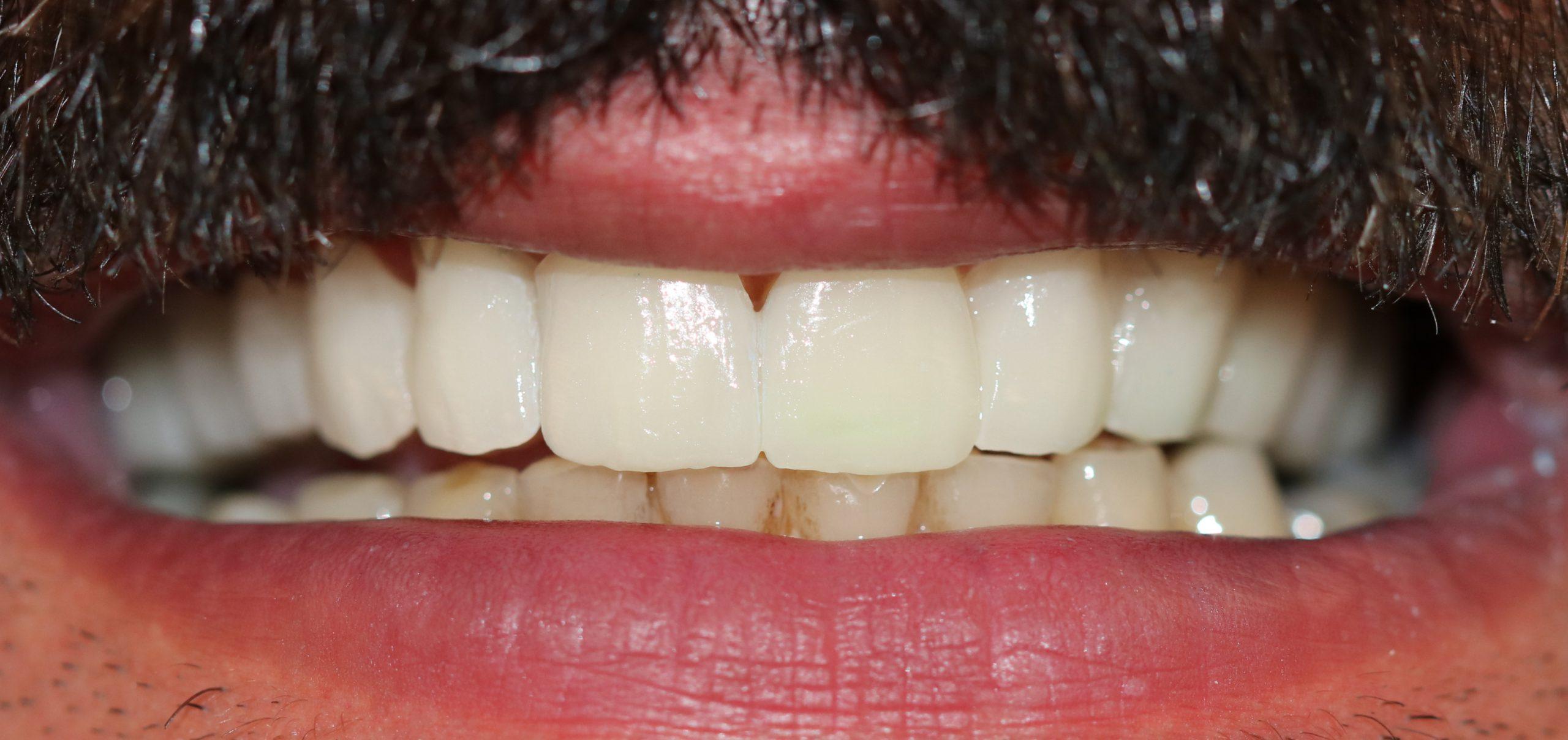 کامپوزیت دندان چیست وچگونه آن را انجام دهیم؟