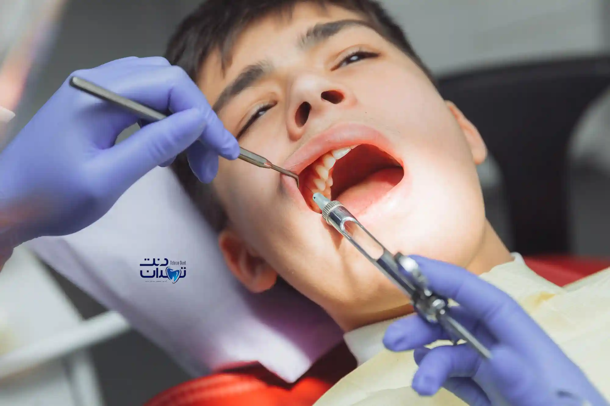 هزینه کشیدن دندان عقل