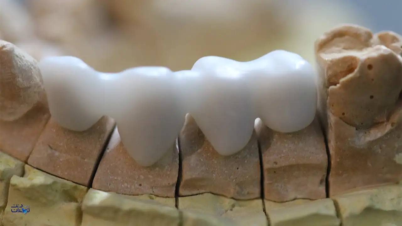 نمونه دندان ساخته شده