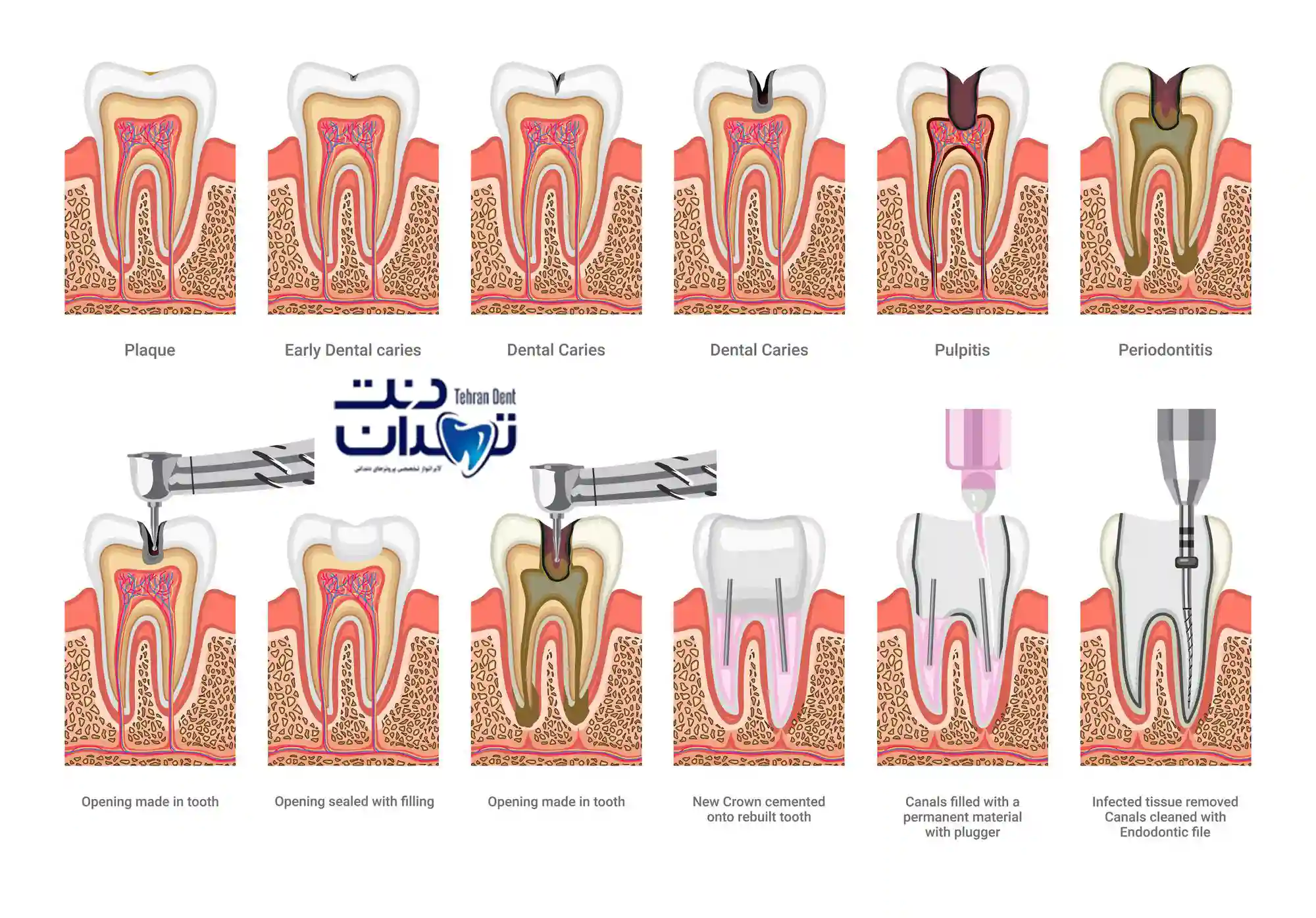 مراحل درمان ریشه دندان و عصب کشی